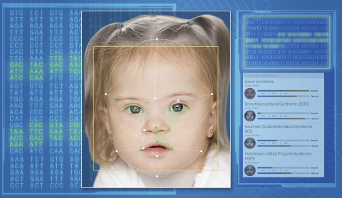 AI Determines Genetic Disorders By Looking At Faces