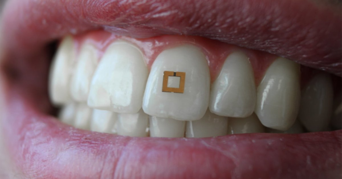This Tiny Tooth-Mounted Sensor Can Monitor What You Eat