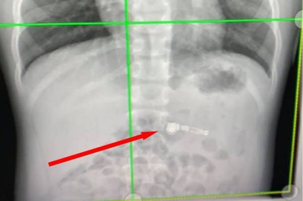 7-Year-Old Boy Rushed To ER After Swallowing An Airpods Earbud