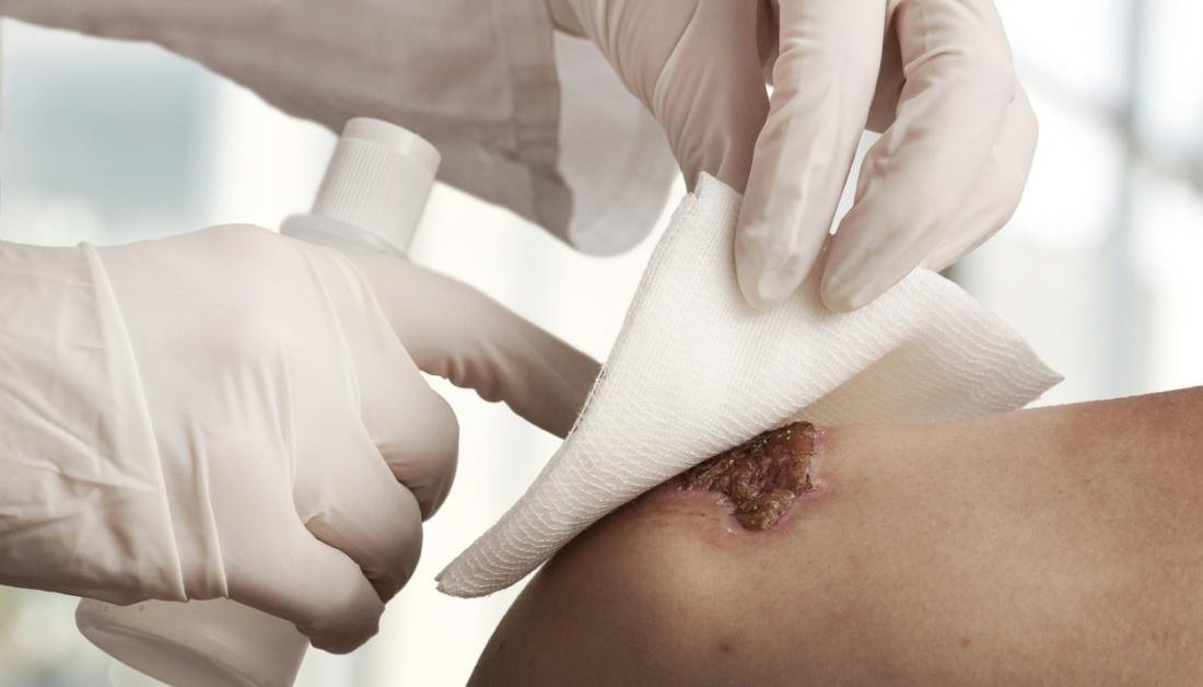 This Smart Bandage Can Change Colors According To Bacteria Infection Level