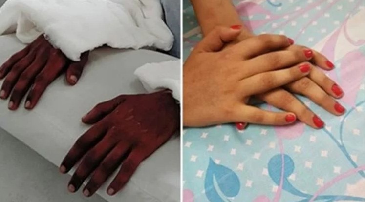 Transplanted Hands Of Amputee Have Mysteriously Changed Color