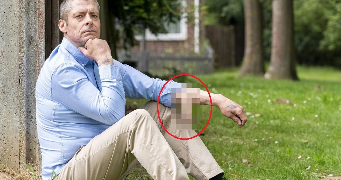 Man's Penis Fell Off Due To Blood Infection, Had A Longer One Grew On His Arm