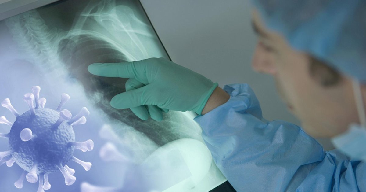 90 Of Recovered COVID19 Patients Suffer From Lung Damage