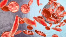 Initial Gene-Editing Trials Show Positive Results In Treating Blood Diseases