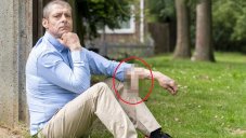 Man's Penis Fell Off Due To Blood Infection, Had A Longer One Grew On His Arm