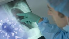 90% Of Recovered COVID-19 Patients Suffer From Lung Damage