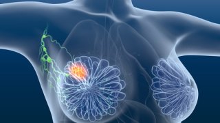Google AI Can Now Detect Breast Cancer Better Than Humans
