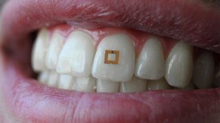 This Tiny Tooth-Mounted Sensor Can Monitor What You Eat