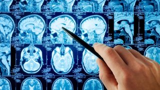 An Indian-Born Doctor And His Students Found The Cure To Brain Cancer