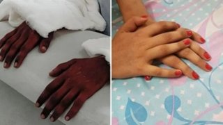 Transplanted Hands Of Amputee Have Mysteriously Changed Color