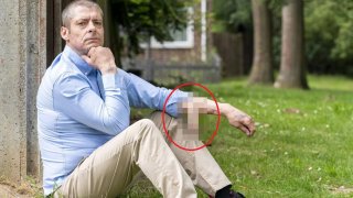 Man's Penis Fell Off Due To Blood Infection, Had A Longer One Grew On His Arm