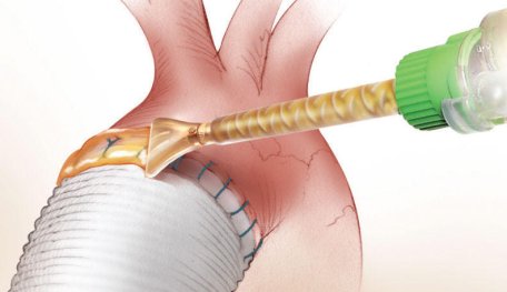 Biological Glue Can Staunch A Cut In Just A Few Seconds