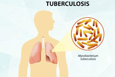 tuberculosis-disease