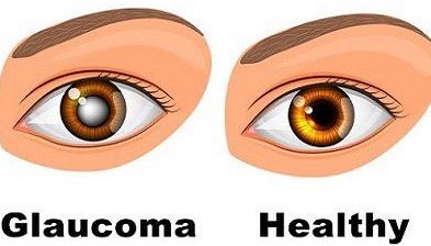 Kết quả hình ảnh cho glaucoma eye