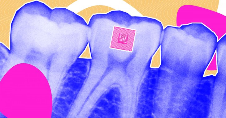 This Tiny Tooth-Mounted Sensor Can Monitor What You Eat - MobyGeek.com