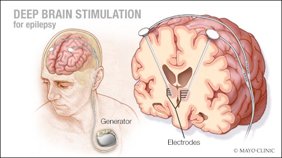 Surgeons Are Using Brain Implants To Treat Addiction - MobyGeek.com