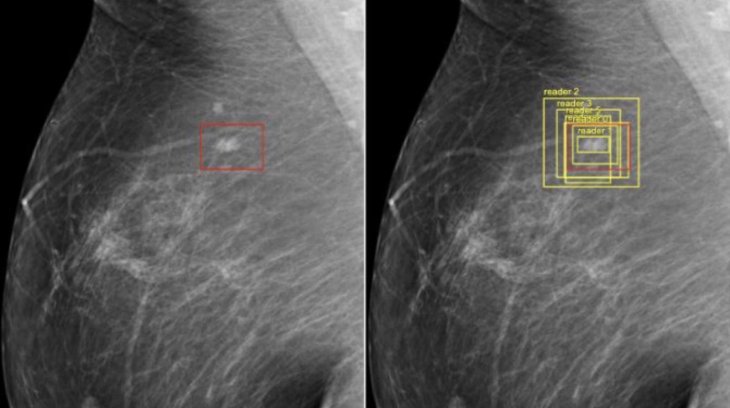 google-ai-detects-breast-cancer-more-accurately-than-doctors-1