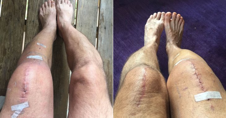 microbot-knee-replacement