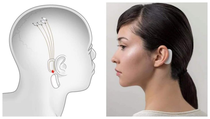 Neuralink Brain Chip Elon Musk