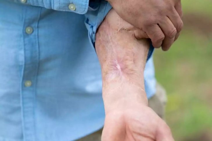 Man lost penis grew new one arm